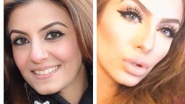 Faryal Makhdoom Picture Before & After Surgery