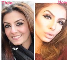 Faryal Makhdoom Picture Before & After Surgery